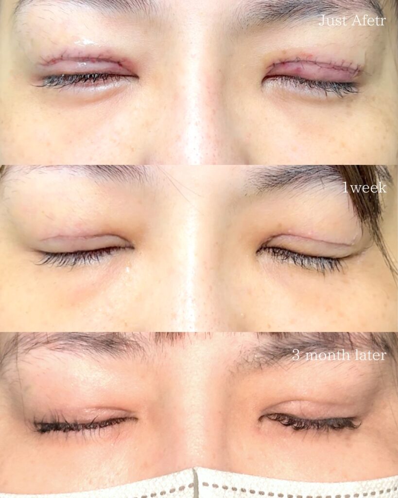 たるみとり併用全切開と眼瞼下垂と涙袋のヒアルロン酸の症例写真 (2)