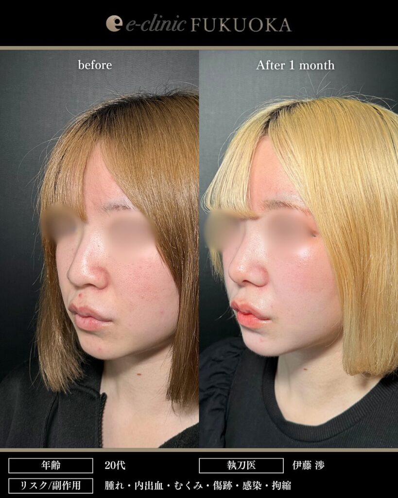 鼻尖形成と軟骨移植と小鼻縮小の症例写真 (24)