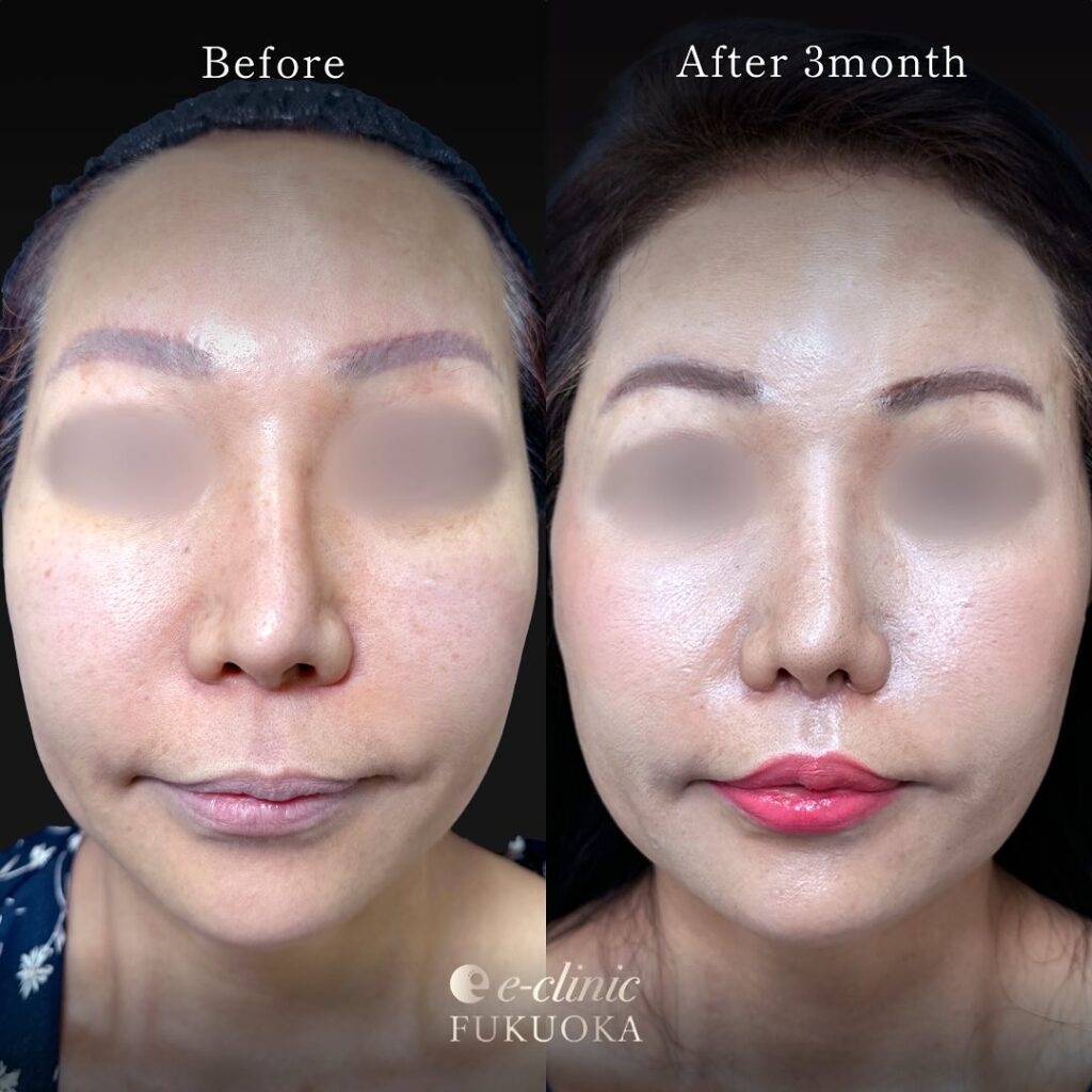 人中短縮と小鼻縮小の症例写真 (6)