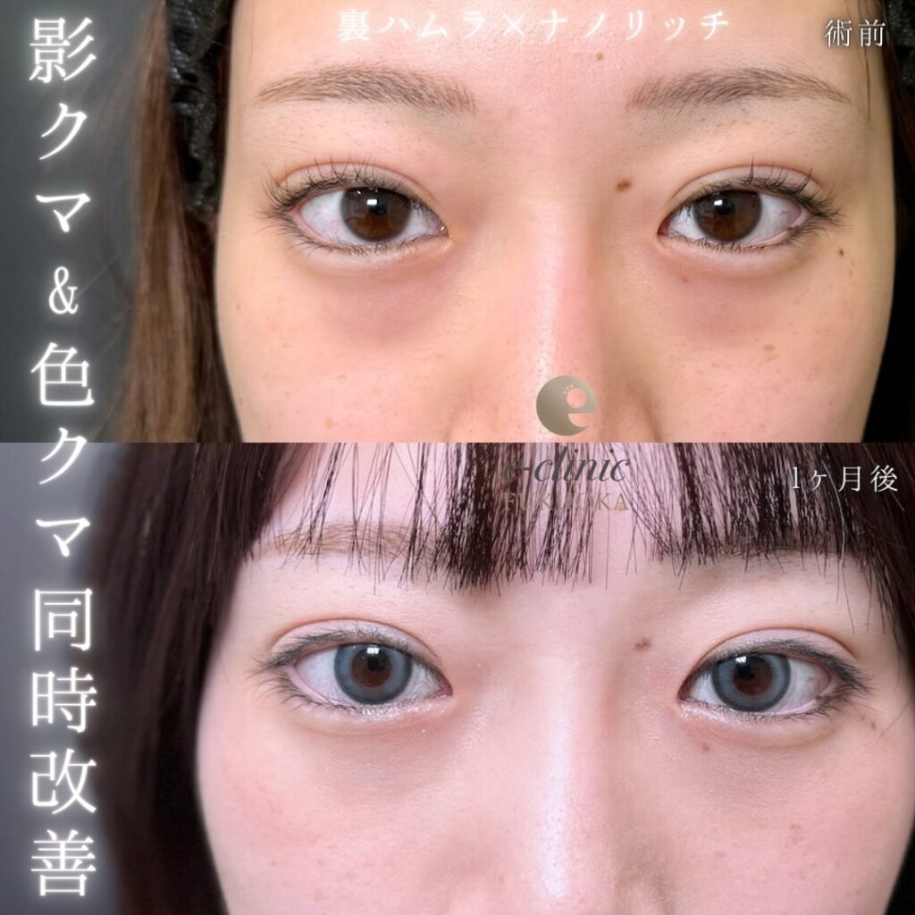 裏ハムラ法と脂肪注入の症例写真 (25)