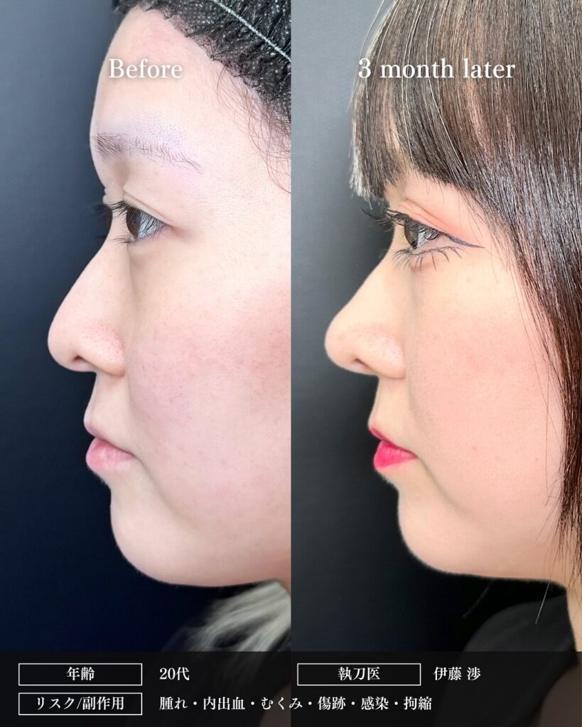 鼻中隔延長と鼻尖形成と軟骨移植と小鼻縮小の症例写真 (7)