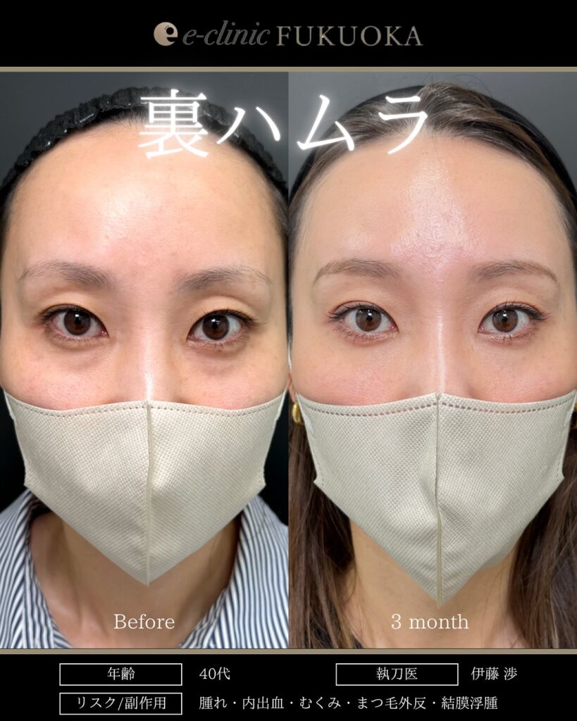 裏ハムラ法の症例写真 (98)