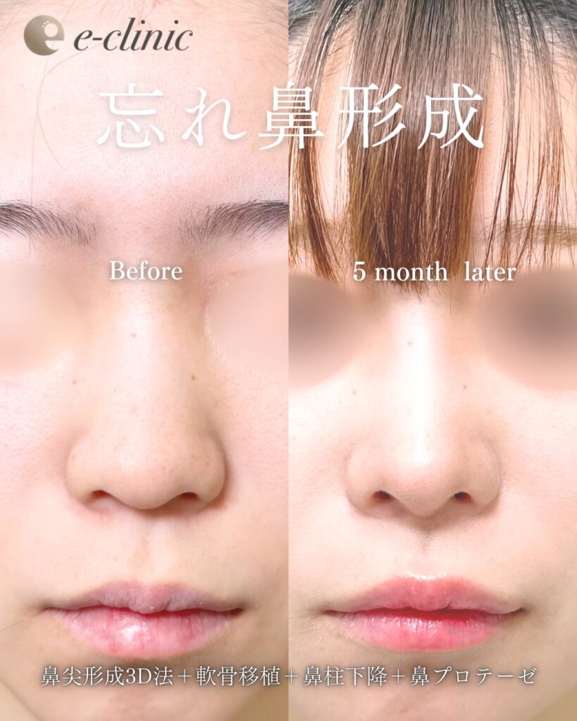 鼻尖形成と軟骨移植と鼻柱下降とプロテーゼの症例写真 (7)