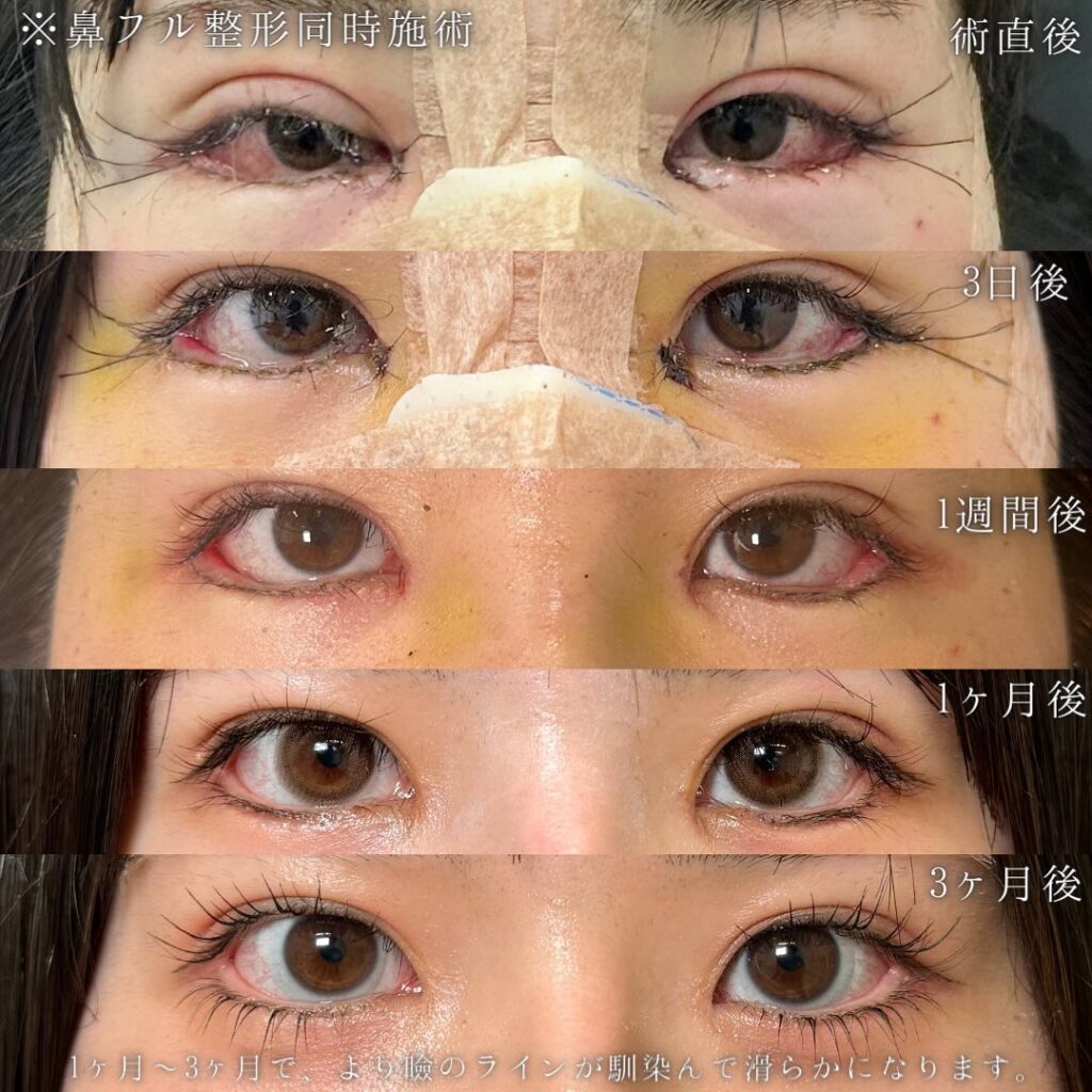 埋没法と目頭切開と目尻切開とタレ目形成の症例写真 (2)