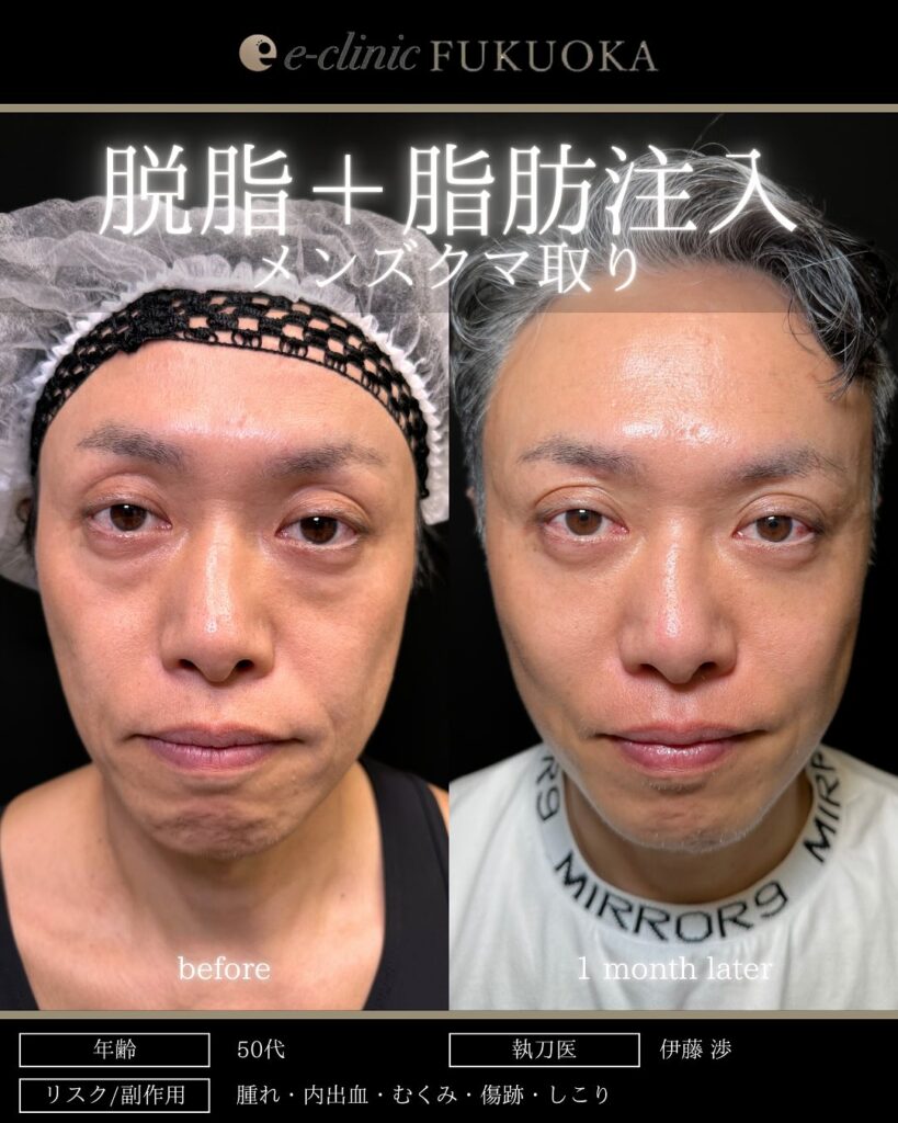 脱脂と脂肪注入の症例写真 (14)