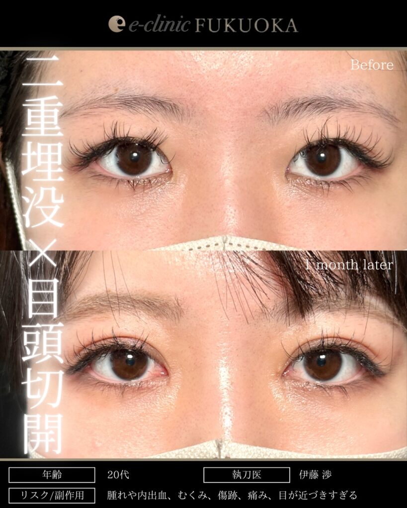 自然癒着法と目頭切開の症例写真 (1)