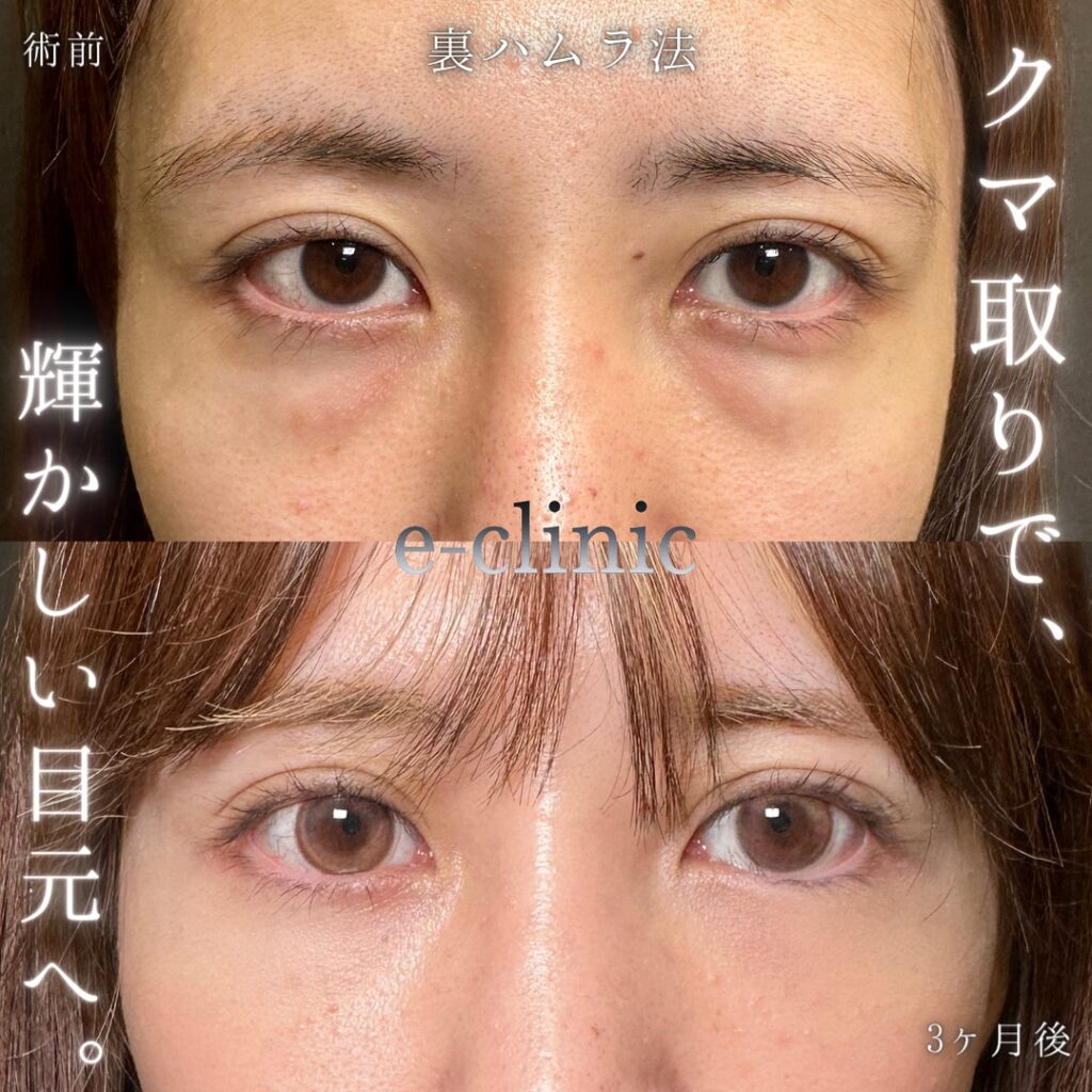 裏ハムラ法の症例写真 (55)