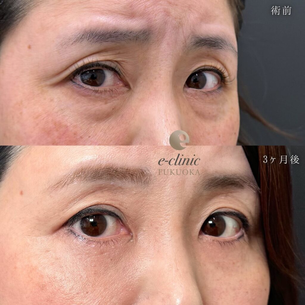 裏ハムラ法と目の下の脂肪注入と額とこめかみの脂肪注入の症例写真 (3)