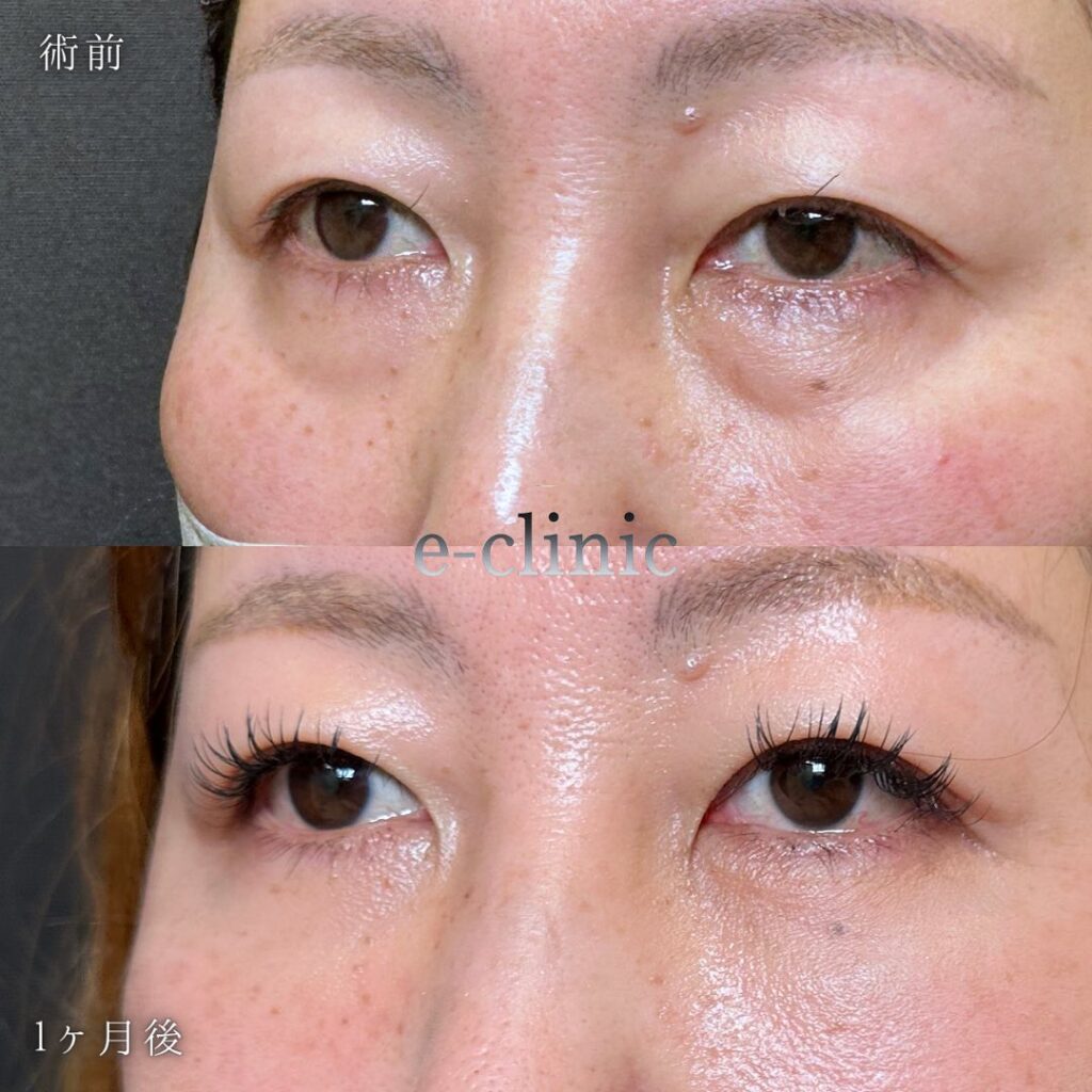 裏ハムラ法の症例写真 (22)