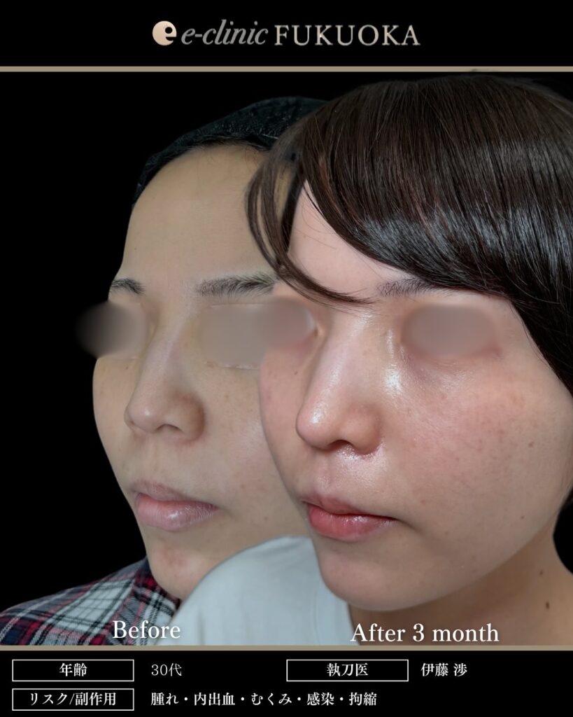 鼻尖形成と軟骨移植と小鼻縮小と鼻柱下降の症例写真 (3)