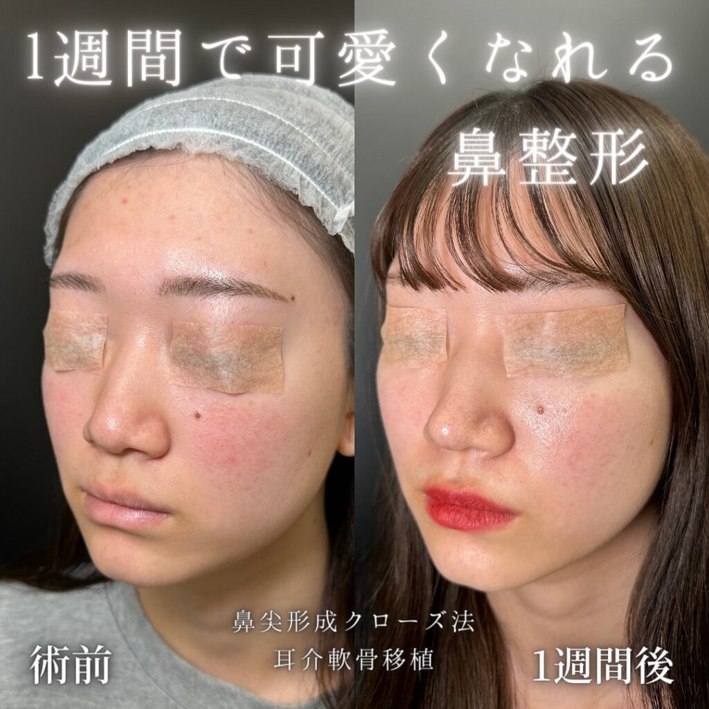 鼻尖形成と軟骨移植の症例写真 (3)