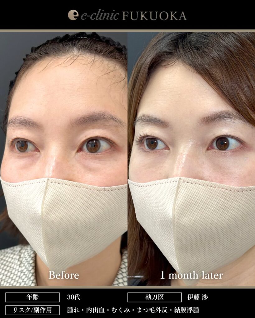 裏ハムラ法の症例写真 (93)