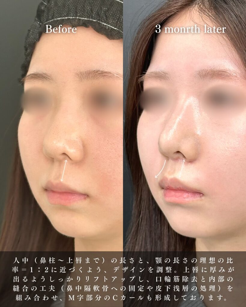 人中短縮の症例写真 (24)