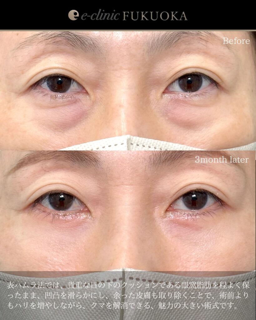 表ハムラ法の症例写真 (5)