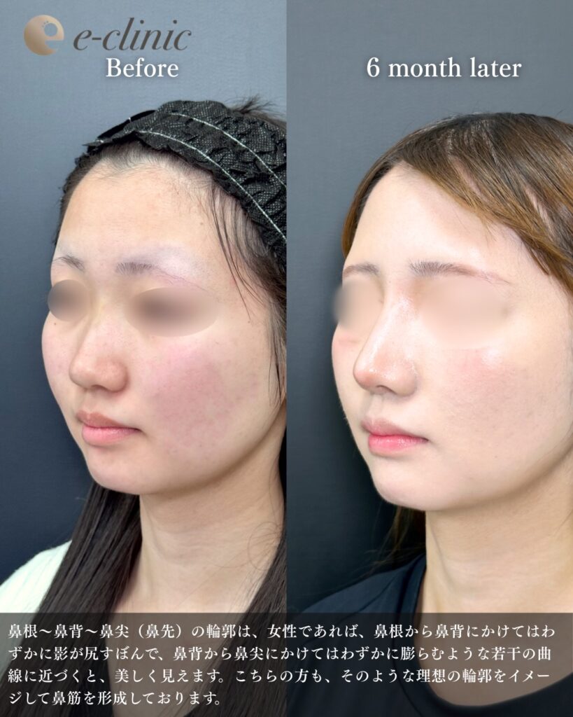 鼻尖形成と耳介軟骨移植とプロテーゼの症例写真 (10)