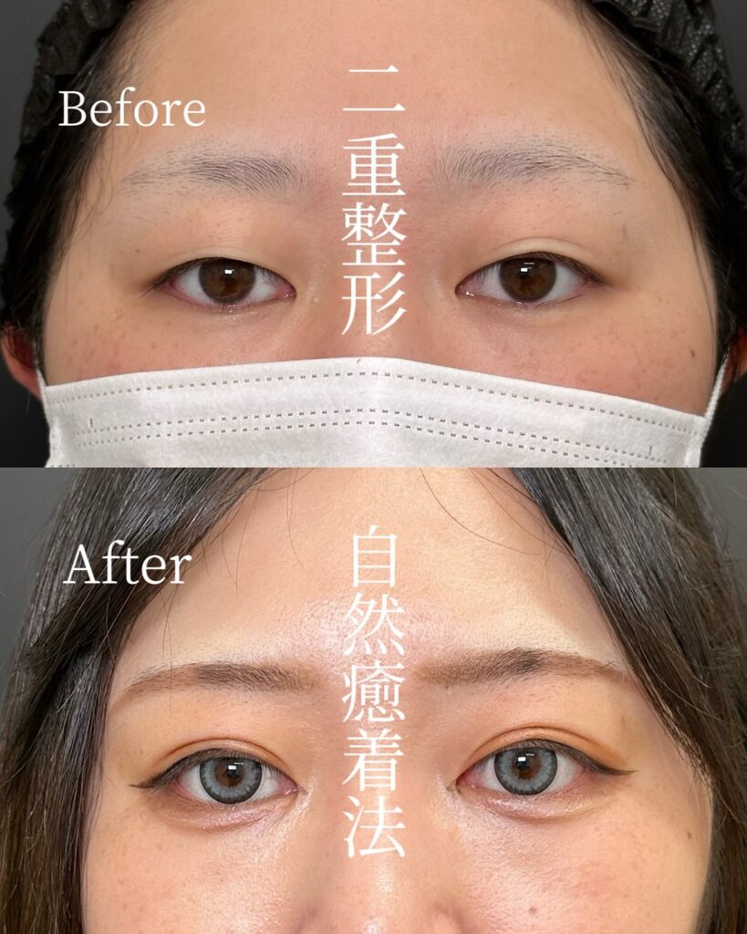 自然癒着法の症例写真