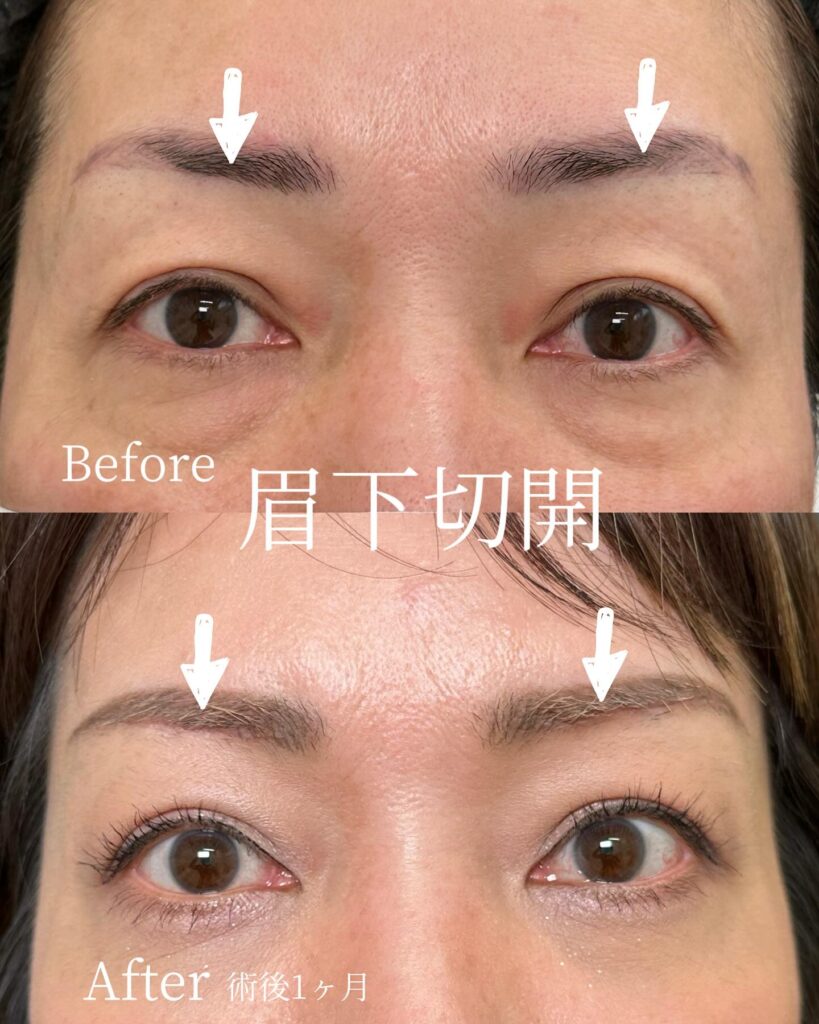 眉下切開の症例写真