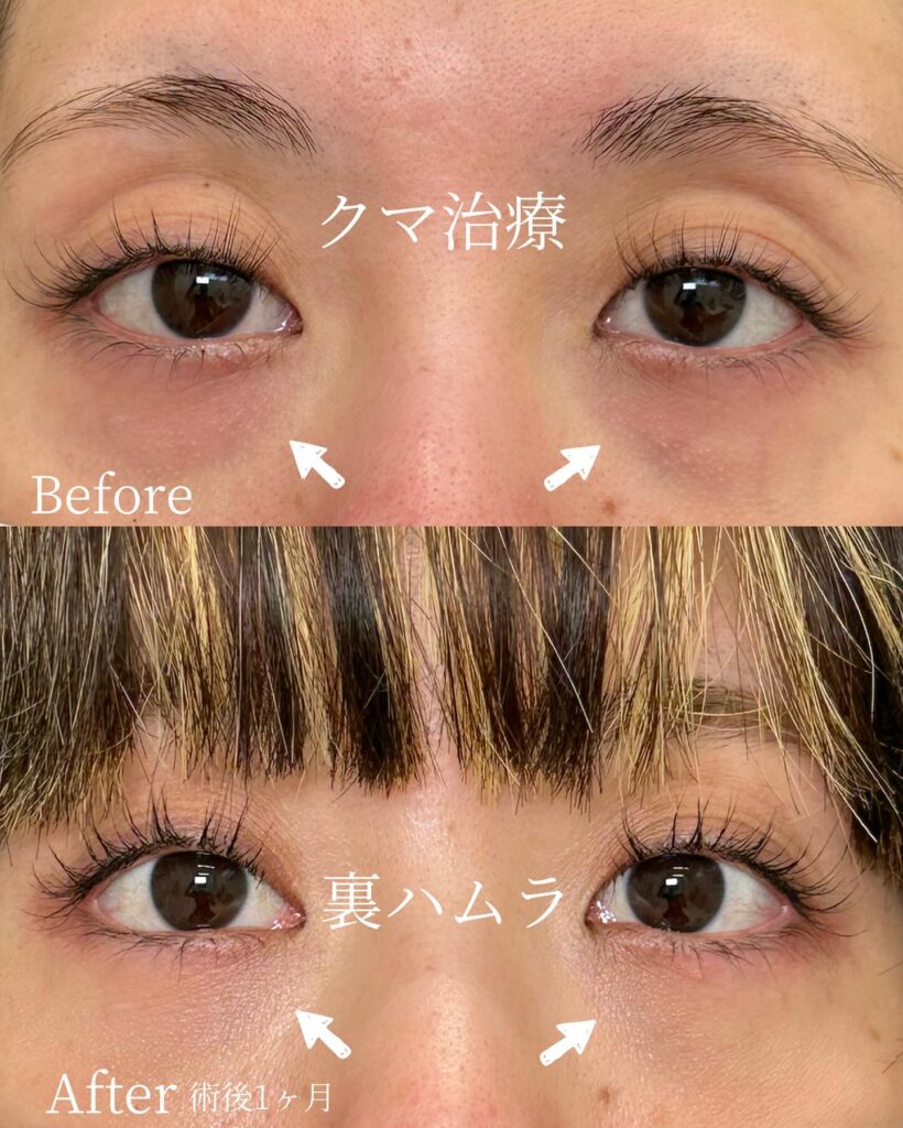 裏ハムラ法の症例写真 (7)