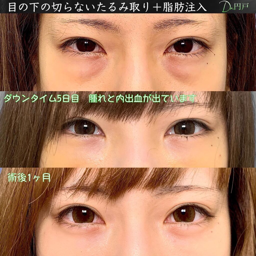 裏ハムラと脂肪注入の５日後と１か月後の症例写真