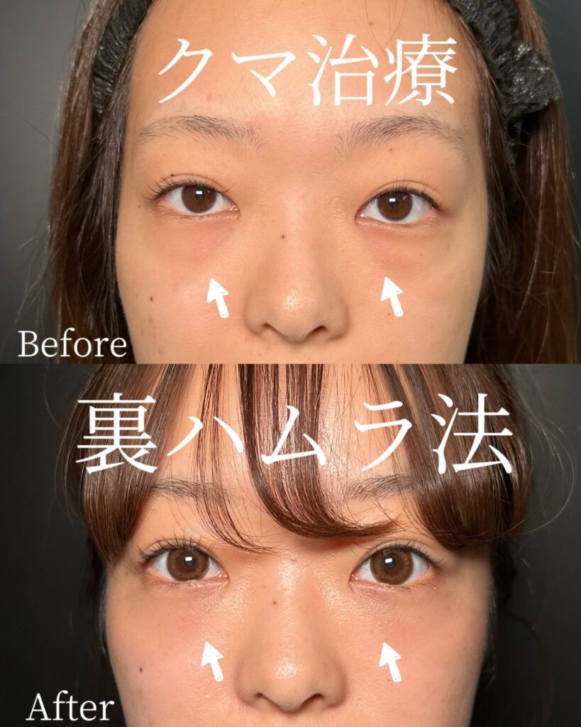 裏ハムラ法の症例写真 (5)