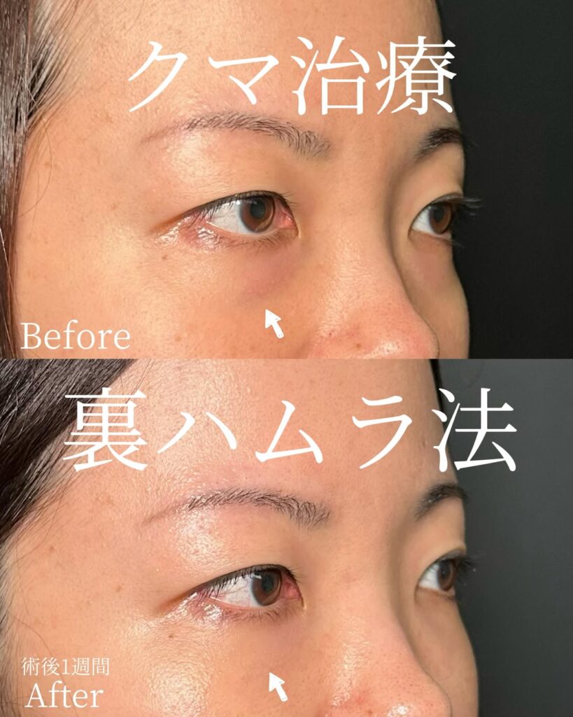 裏ハムラ法の症例写真 (2)