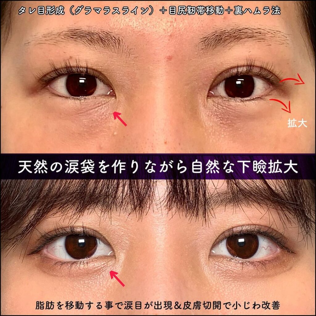 タレ目形成と目尻切開と裏ハムラ法の症例写真