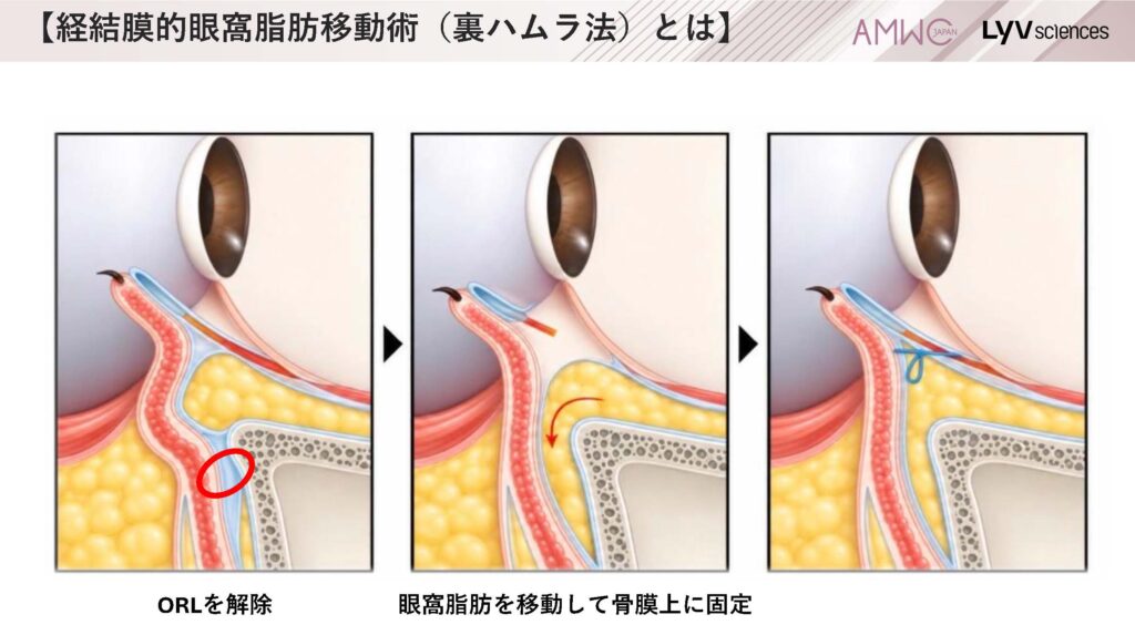 10_経結膜的眼窩脂肪移動術(裏ハムラ法)とは