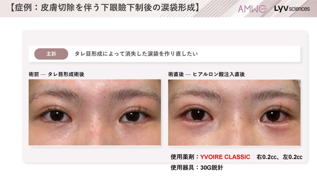 22_症例:皮膚切除を伴う下眼瞼下制後の涙袋形成